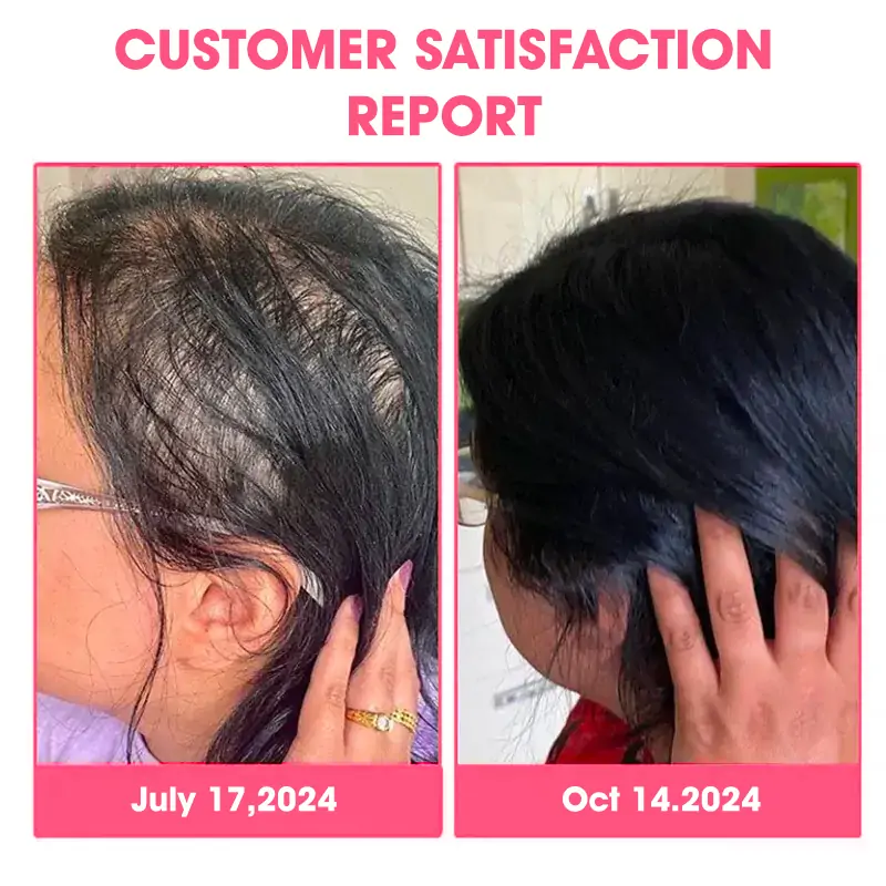 ✨️DeeVoo™   Luxe Bee venom Scalp Treatment HairGrᴏᴡth Hair Spray(Hurry, 80% OFF - Only 30 minutes left 🫧)
