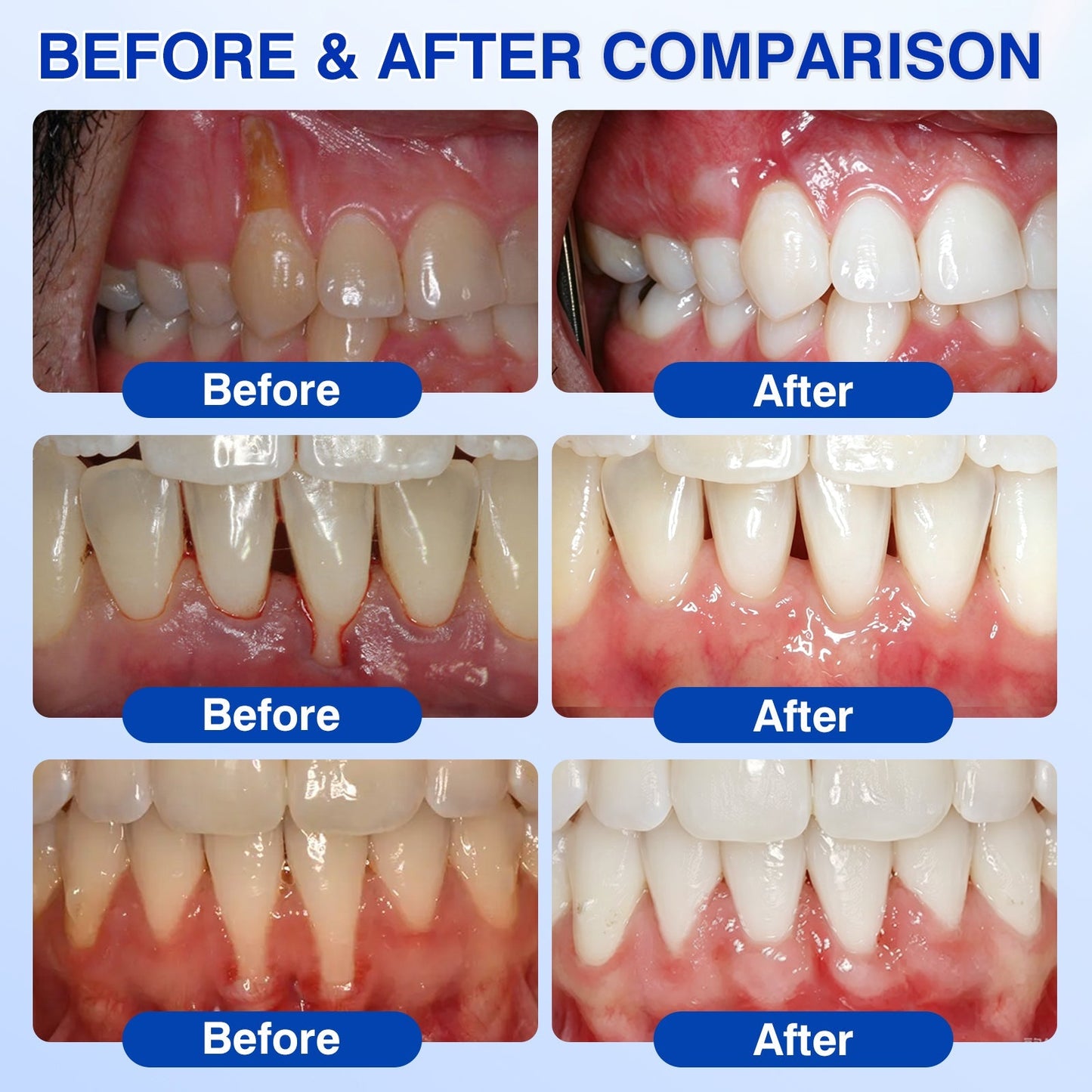 ❤️🦷Evolvion® GumVital Advanced Gum Care Gel🛡️🎁