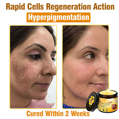 FDA Approved: Ourlyard® Bee Venom Skin Restoration Cream — 🔥Limited Time 80% OFF🔥