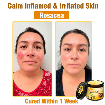 FDA Approved: Ourlyard® Bee Venom Skin Restoration Cream — 🔥Limited Time 80% OFF🔥