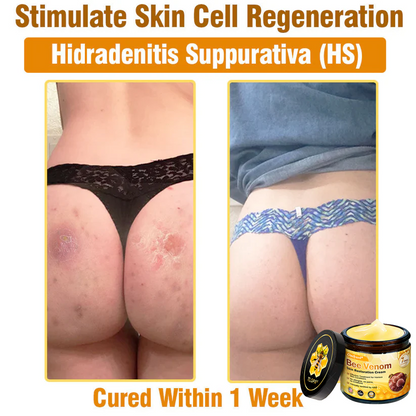 FDA Approved: Ourlyard® Bee Venom Skin Restoration Cream — 🔥Limited Time 80% OFF🔥