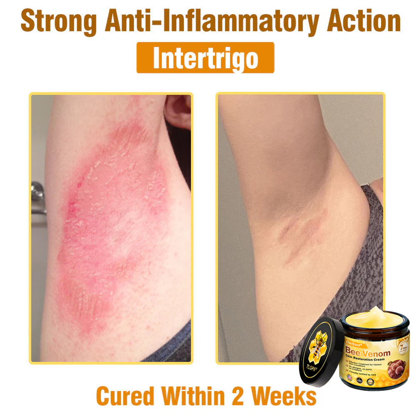 FDA Approved: Ourlyard® Bee Venom Skin Restoration Cream — 🔥Limited Time 80% OFF🔥