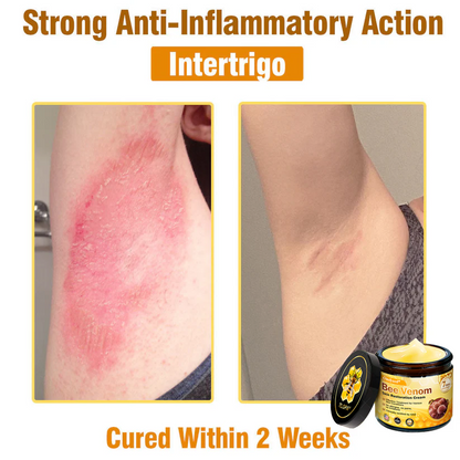 FDA Approved: Ourlyard® Bee Venom Skin Restoration Cream — 🔥Limited Time 80% OFF🔥