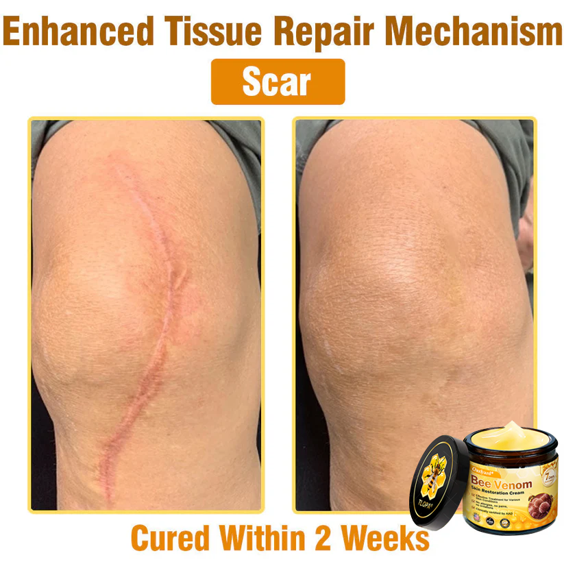 FDA Approved: Ourlyard® Bee Venom Skin Restoration Cream — 🔥Limited Time 80% OFF🔥